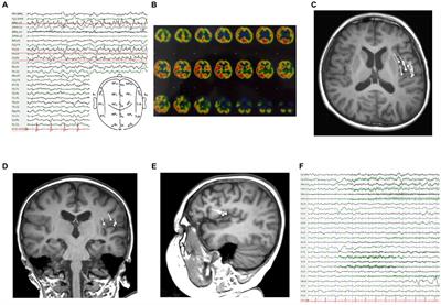 Misdirection due to early magnetoencephalographic presentation and management in Rasmussen encephalitis: a case report